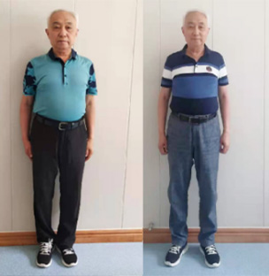 重度肥胖合并高血压案例