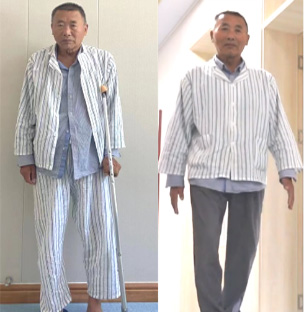 较重糖尿病案例